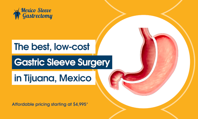 Best Affordable Gastric Sleeve Surgery in Tijuana, Mexico